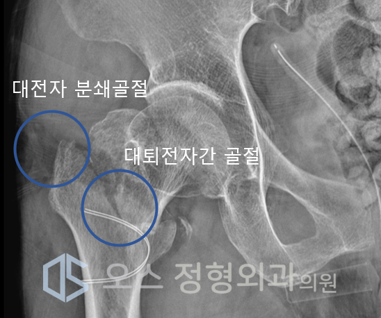 고관절 복합골절 엑스레이사진