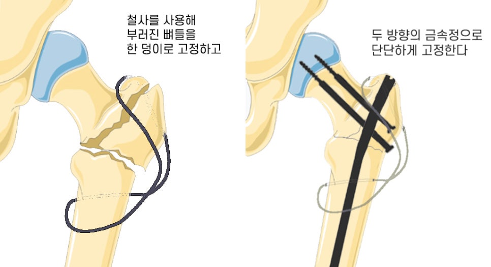 오스정형외과의 복합고관절골절 수술사례