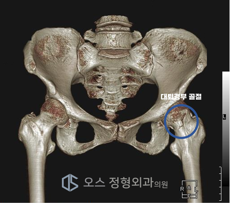 대퇴경부골절 CT사진