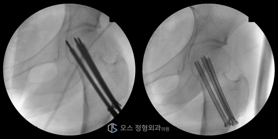 대퇴경부골절수술 유관나사 삽입 사진