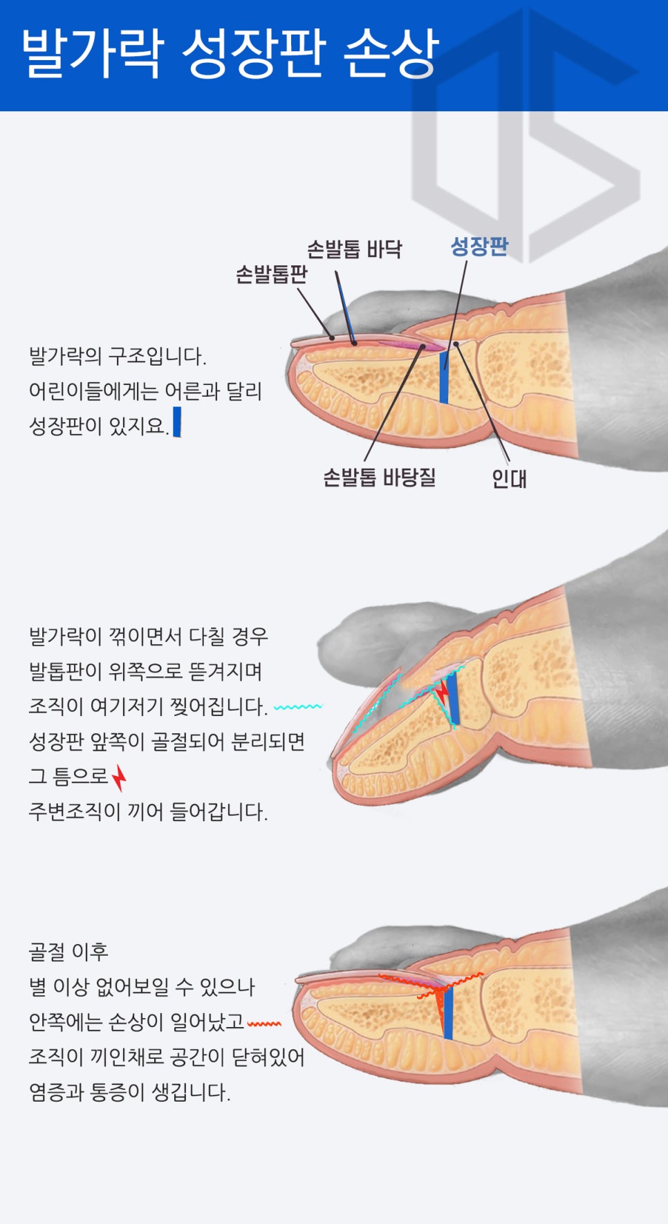 어린이 발가락성장판손상 해부도