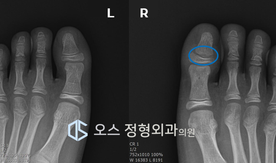 소아발가락 성장판 손상 엑스레이사진