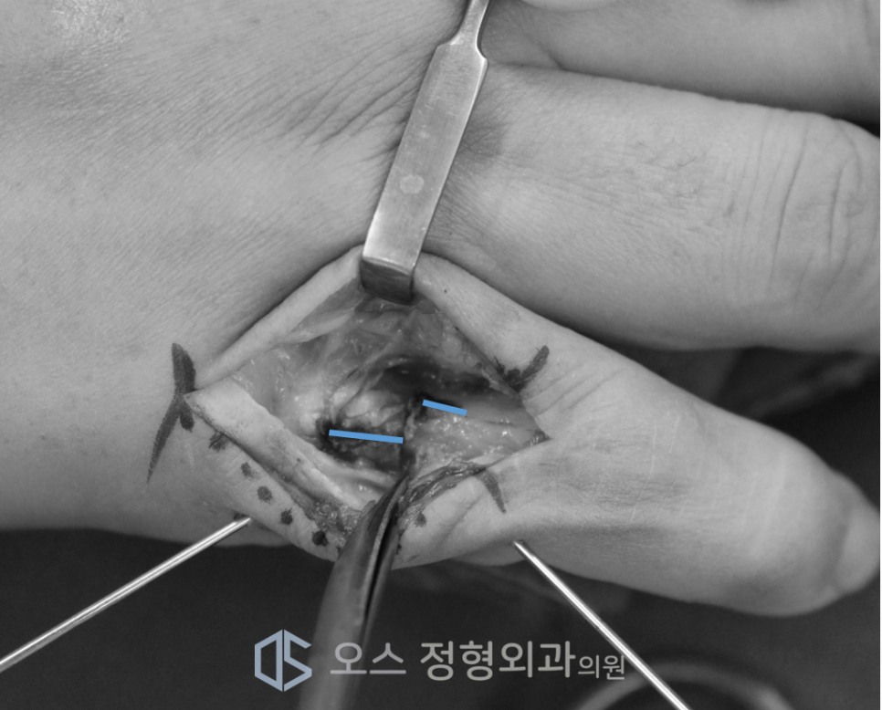 골절후 부정유합교정술 과정