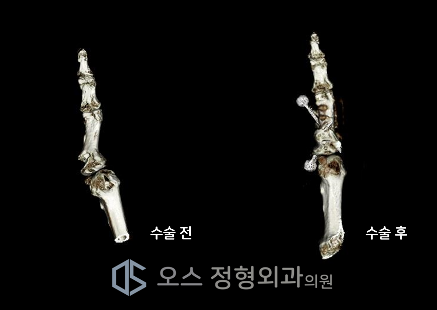 부정유합교정 절골내고정술 전후 CT사진