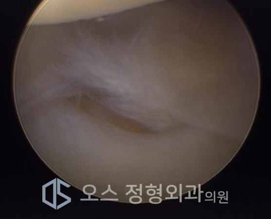 삼각섬유연골복합체 파열의 관절경 사진