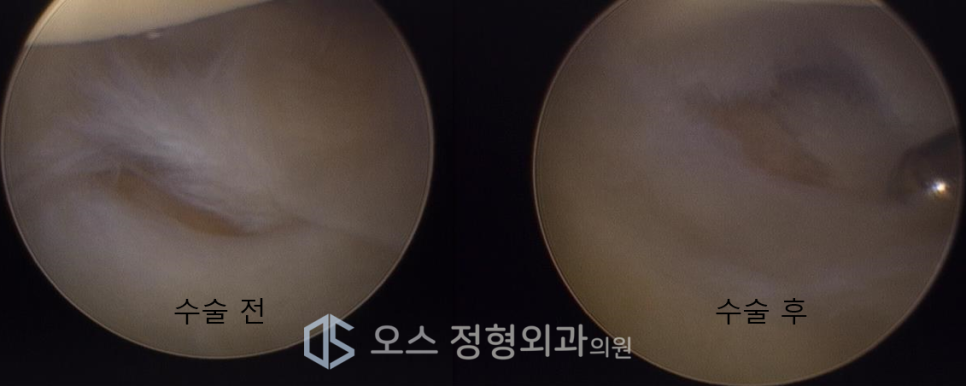관절경을 이용한 TFCC 수술 장면