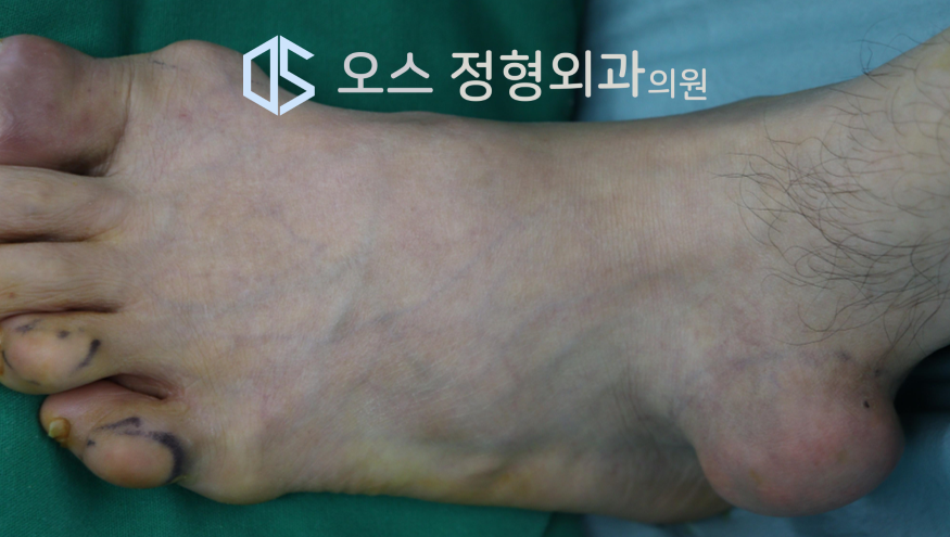 통풍결절사진