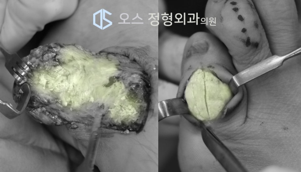통풍결절 제거 수술 과정