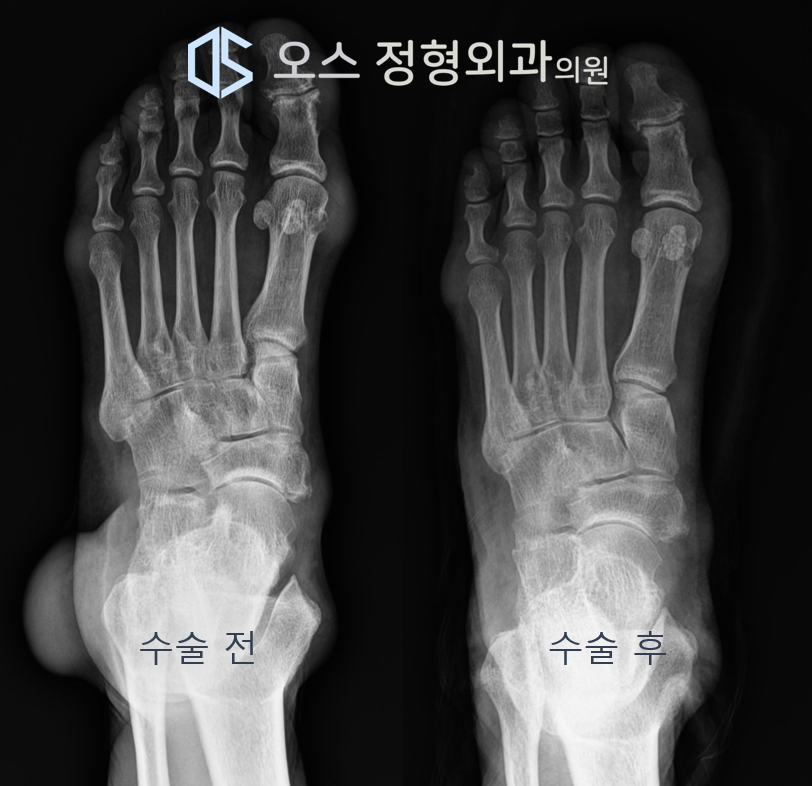 통풍결절 제거수술 전후 비교 