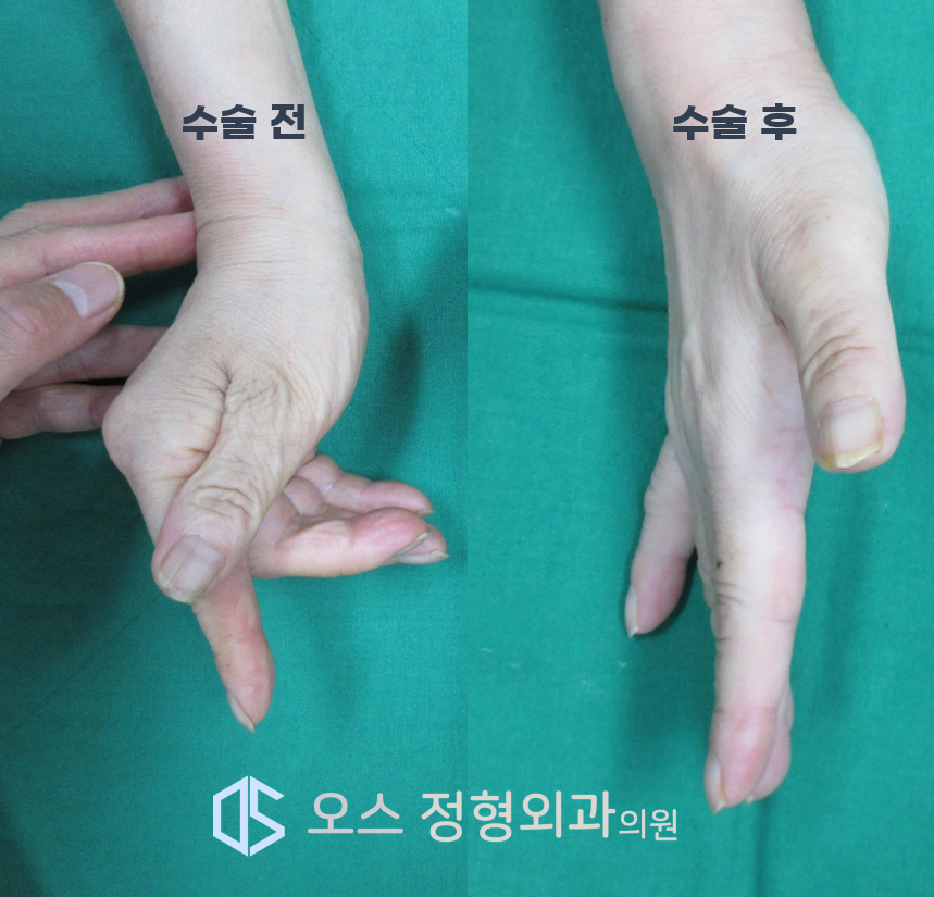 손가락 힘줄전이술 전후 비교